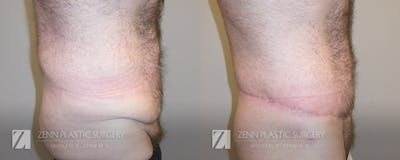 Tummy Tuck Before & After Gallery - Patient 106400619 - Image 2