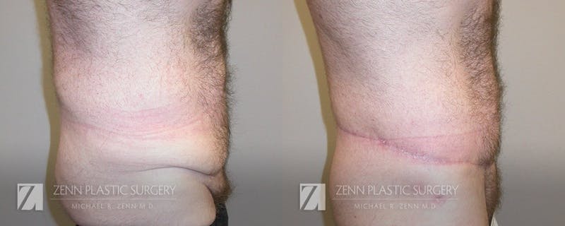 Tummy Tuck Before & After Gallery - Patient 106400619 - Image 2