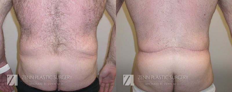 Tummy Tuck Before & After Gallery - Patient 106400619 - Image 3