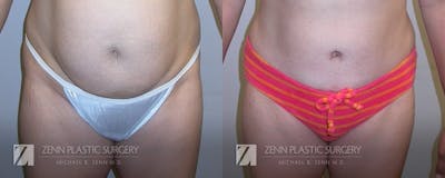 Tummy Tuck Before & After Gallery - Patient 106400620 - Image 1