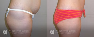 Tummy Tuck Before & After Gallery - Patient 106400620 - Image 2