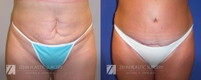 Tummy Tuck Before & After Gallery - Patient 106400621 - Image 1