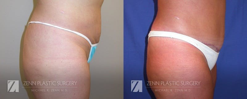 Tummy Tuck Before & After Gallery - Patient 106400621 - Image 2