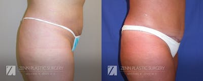 Tummy Tuck Before & After Gallery - Patient 106400621 - Image 2