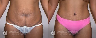 Tummy Tuck Before & After Gallery - Patient 106400622 - Image 1