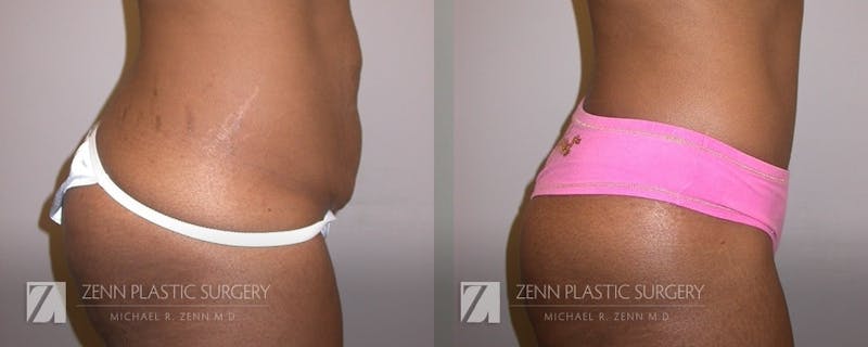 Tummy Tuck Before & After Gallery - Patient 106400622 - Image 2