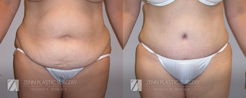 Tummy Tuck Before & After Gallery - Patient 106400623 - Image 1