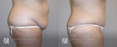 Tummy Tuck Before & After Gallery - Patient 106400623 - Image 2