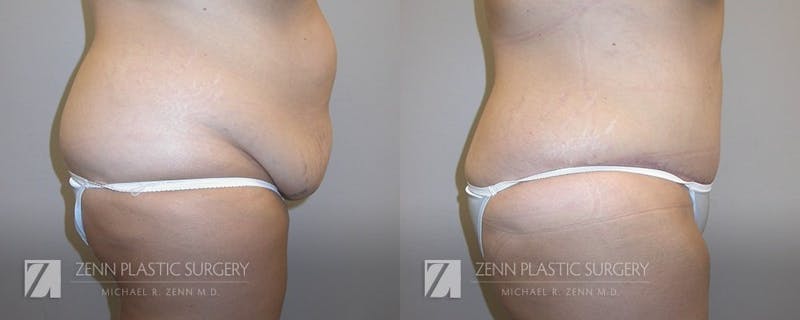 Tummy Tuck Before & After Gallery - Patient 106400623 - Image 2