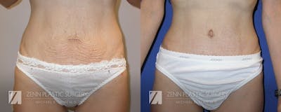 Tummy Tuck Before & After Gallery - Patient 106400624 - Image 1