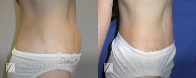 Tummy Tuck Before & After Gallery - Patient 106400624 - Image 2