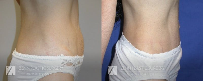 Tummy Tuck Before & After Gallery - Patient 106400624 - Image 2