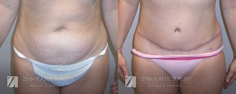 Tummy Tuck Before & After Gallery - Patient 106400625 - Image 1
