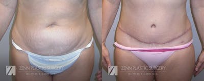 Tummy Tuck Before & After Gallery - Patient 106400625 - Image 1