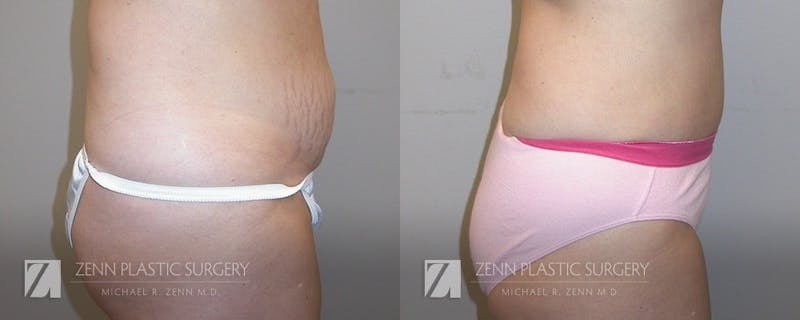 Tummy Tuck Before & After Gallery - Patient 106400625 - Image 2