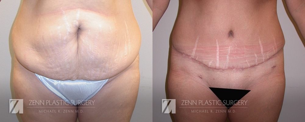 Patient 106400626 | Tummy Tuck Before & After Photos | Zenn