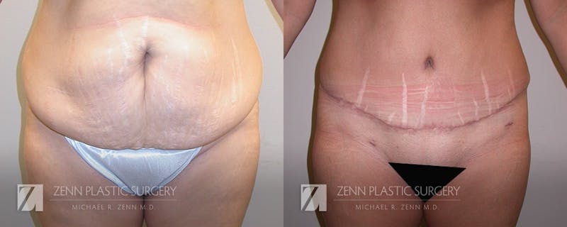 Tummy Tuck Before & After Gallery - Patient 106400626 - Image 1