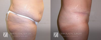 Tummy Tuck Before & After Gallery - Patient 106400626 - Image 2