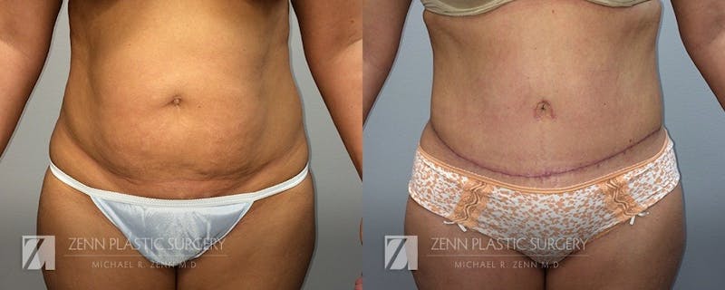 Tummy Tuck Before & After Gallery - Patient 106400627 - Image 1
