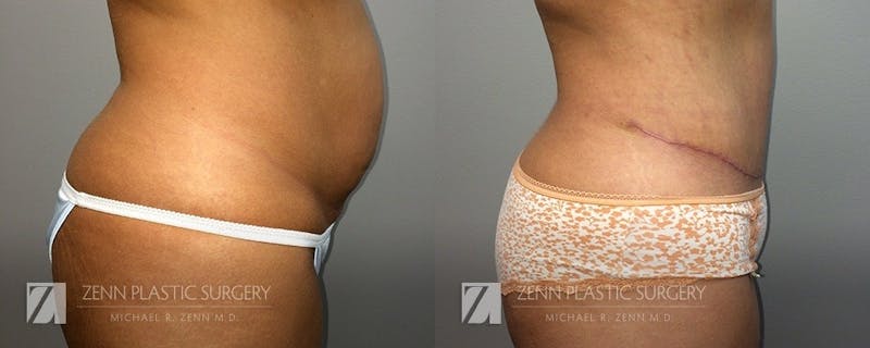 Tummy Tuck Before & After Gallery - Patient 106400627 - Image 2