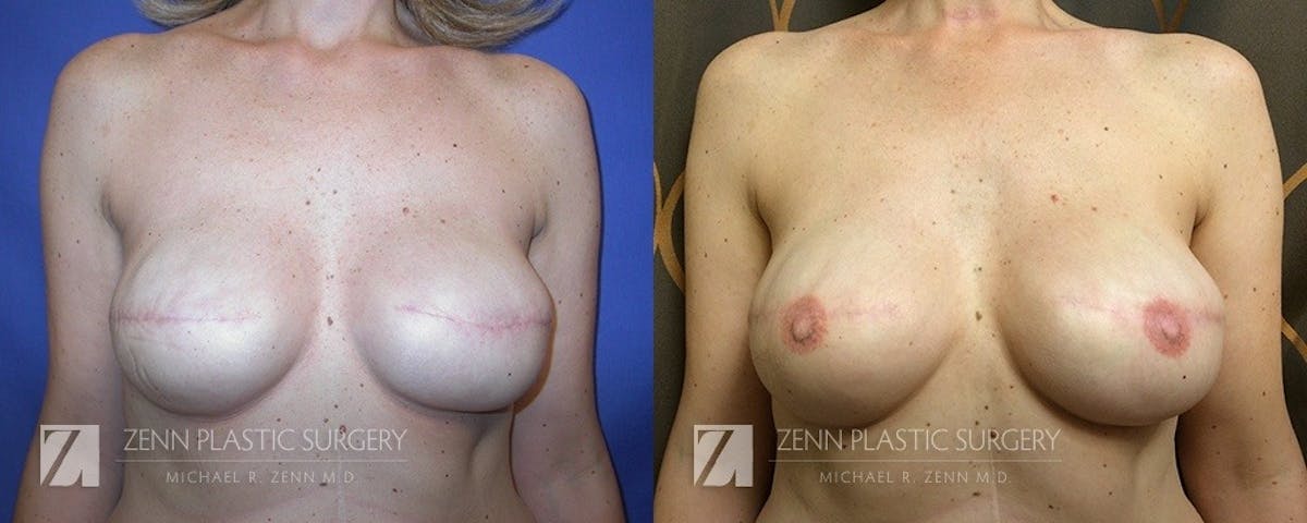 Breast Reconstruction Before & After Gallery - Patient 106400630 - Image 2