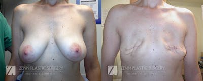 Breast Reconstruction Before & After Gallery - Patient 106400630 - Image 1
