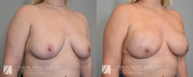 Breast Reconstruction Before & After Gallery - Patient 106400635 - Image 2
