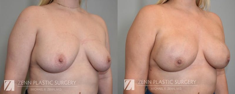 Breast Reconstruction Before & After Gallery - Patient 106400635 - Image 2