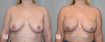Breast Reconstruction Before & After Gallery - Patient 106400635 - Image 1