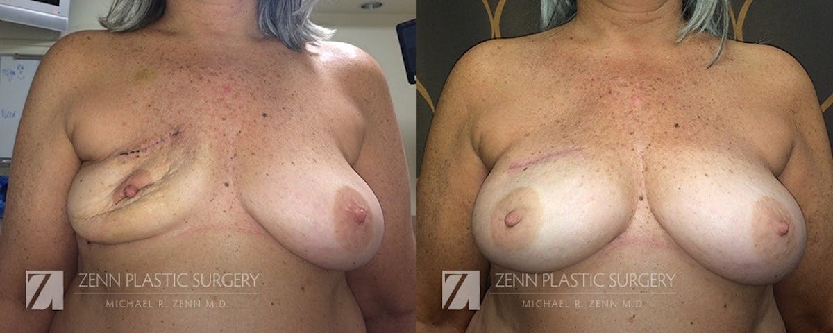 Breast Reconstruction Before & After Gallery - Patient 106400638 - Image 1