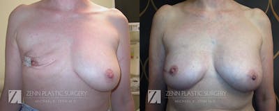 Breast Reconstruction Before & After Gallery - Patient 106400639 - Image 1