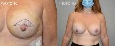Breast Reconstruction Before & After Gallery - Patient 106400641 - Image 2