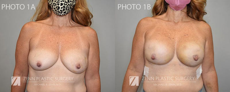 Breast Reconstruction Before & After Gallery - Patient 106400641 - Image 1