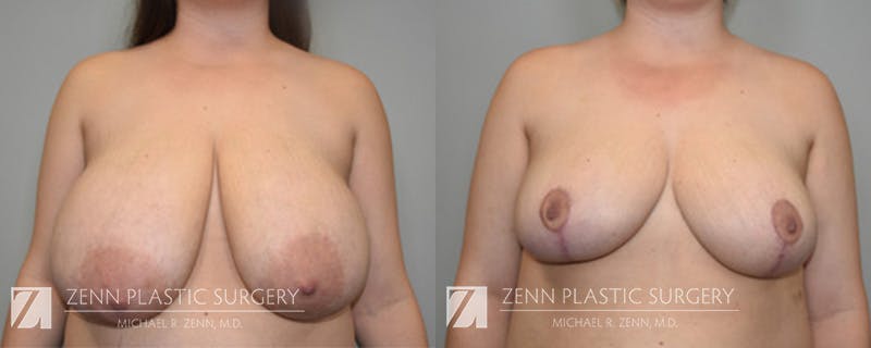 Breast Reduction Before & After Gallery - Patient 176761550 - Image 1