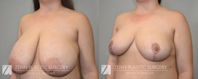 Breast Reduction Before & After Gallery - Patient 176761550 - Image 2