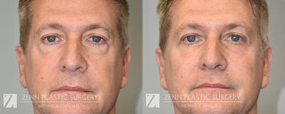 Blepharoplasty / Browlift Before & After Gallery - Patient 237798 - Image 1