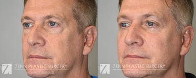 Blepharoplasty / Browlift Before & After Gallery - Patient 237798 - Image 2