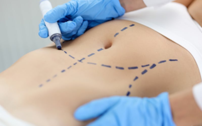 A woman with lines drawn on her tummy