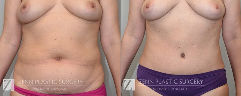 Mommy Makeover Before & After Gallery - Patient 106400618 - Image 1