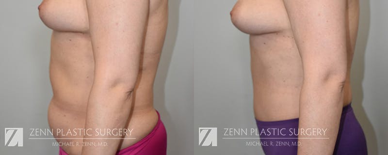 Mommy Makeover Before & After Gallery - Patient 106400618 - Image 2