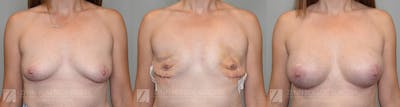 Breast Reconstruction Before & After Gallery - Patient 705052 - Image 1