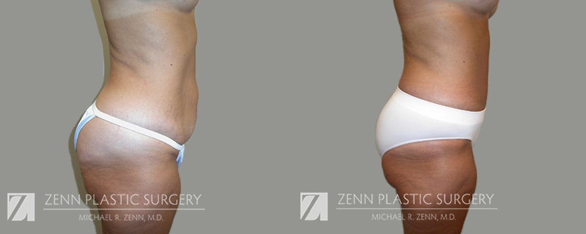 Mommy Makeover Before & After Gallery - Patient 106400601 - Image 4