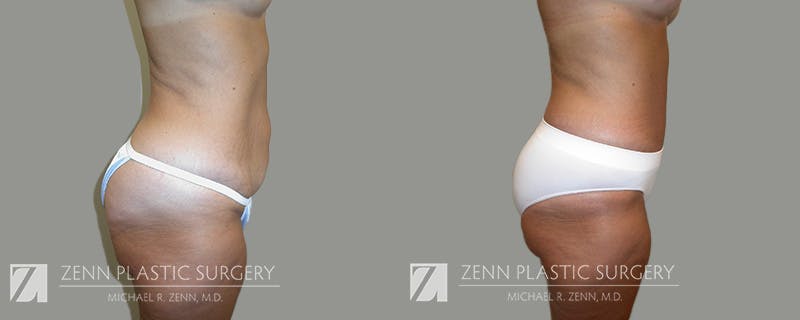 Mommy Makeover Before & After Gallery - Patient 106400601 - Image 4