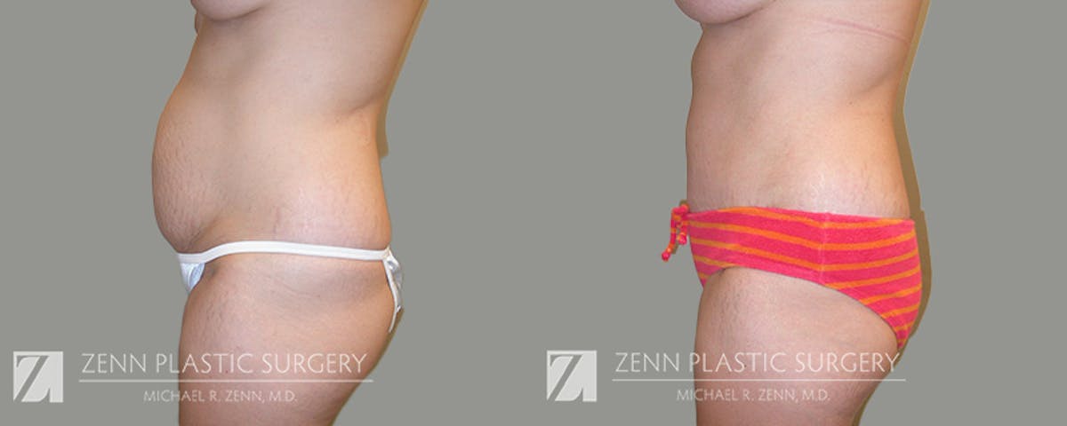 Mommy Makeover Before & After Gallery - Patient 106400607 - Image 4