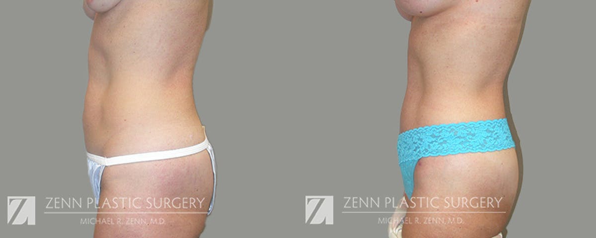 Mommy Makeover Before & After Gallery - Patient 422632 - Image 4
