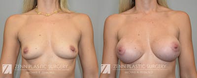 Breast Augmentation Before & After Gallery - Patient 294469 - Image 1