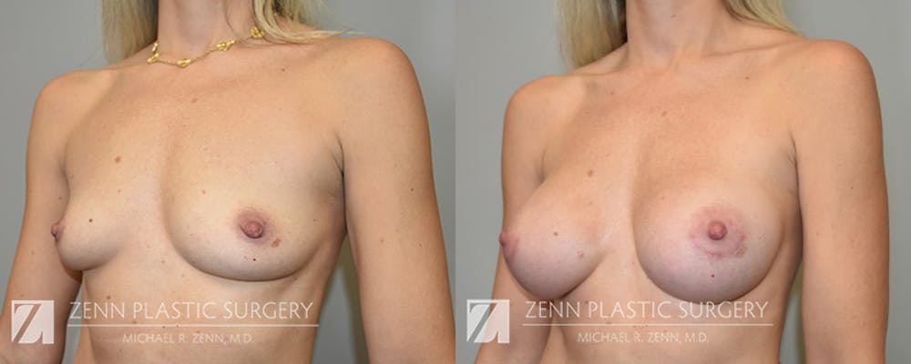 Breast Augmentation Before & After Gallery - Patient 294469 - Image 2