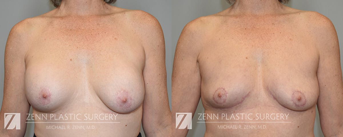 Breast Implant Removal Before & After Gallery - Patient 588774 - Image 1