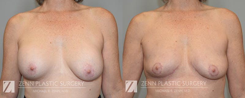 Breast Implant Removal Before & After Gallery - Patient 588774 - Image 1