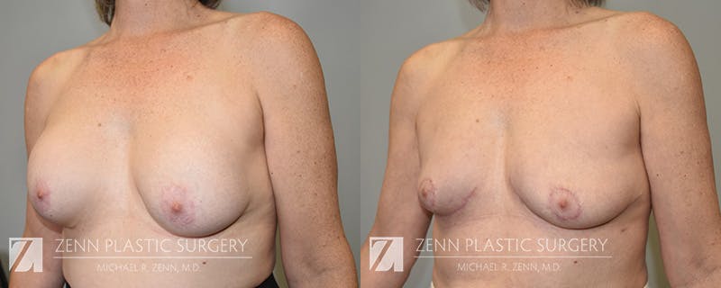 Breast Implant Removal Before & After Gallery - Patient 588774 - Image 2